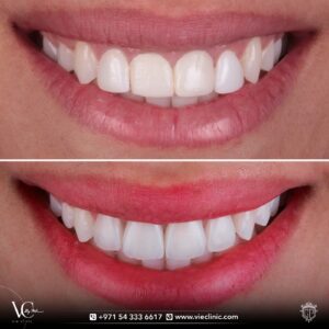 Dental veneers case before and after