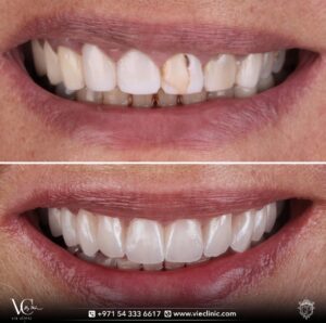 Dental veneers case before and after